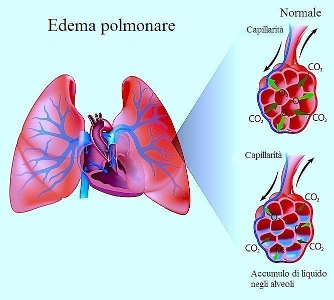 Edema polmonare acuto cardiogeno e non, cause, sintomi e..