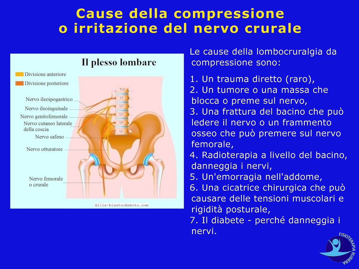 Cause-della-compressione-o-irritazione-del-nervo-crurale