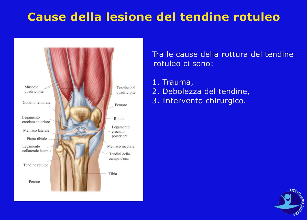 Cause della lesione del tendine rotuleo