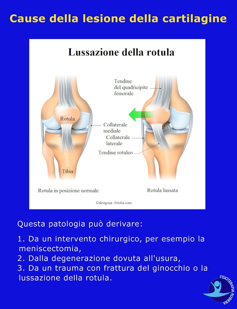 Cause-della-lesione-della-cartilagine