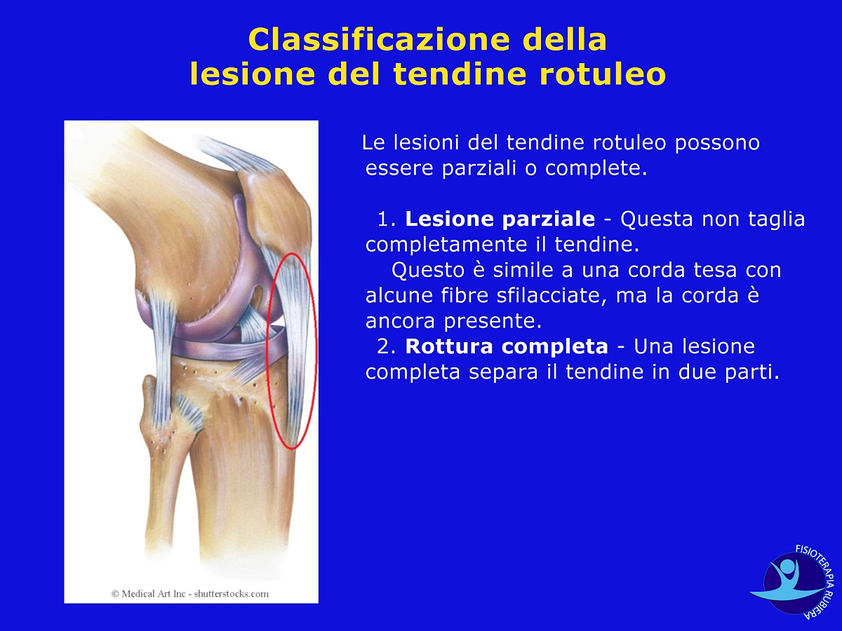 Classificazione della lesione del tendine rotuleo