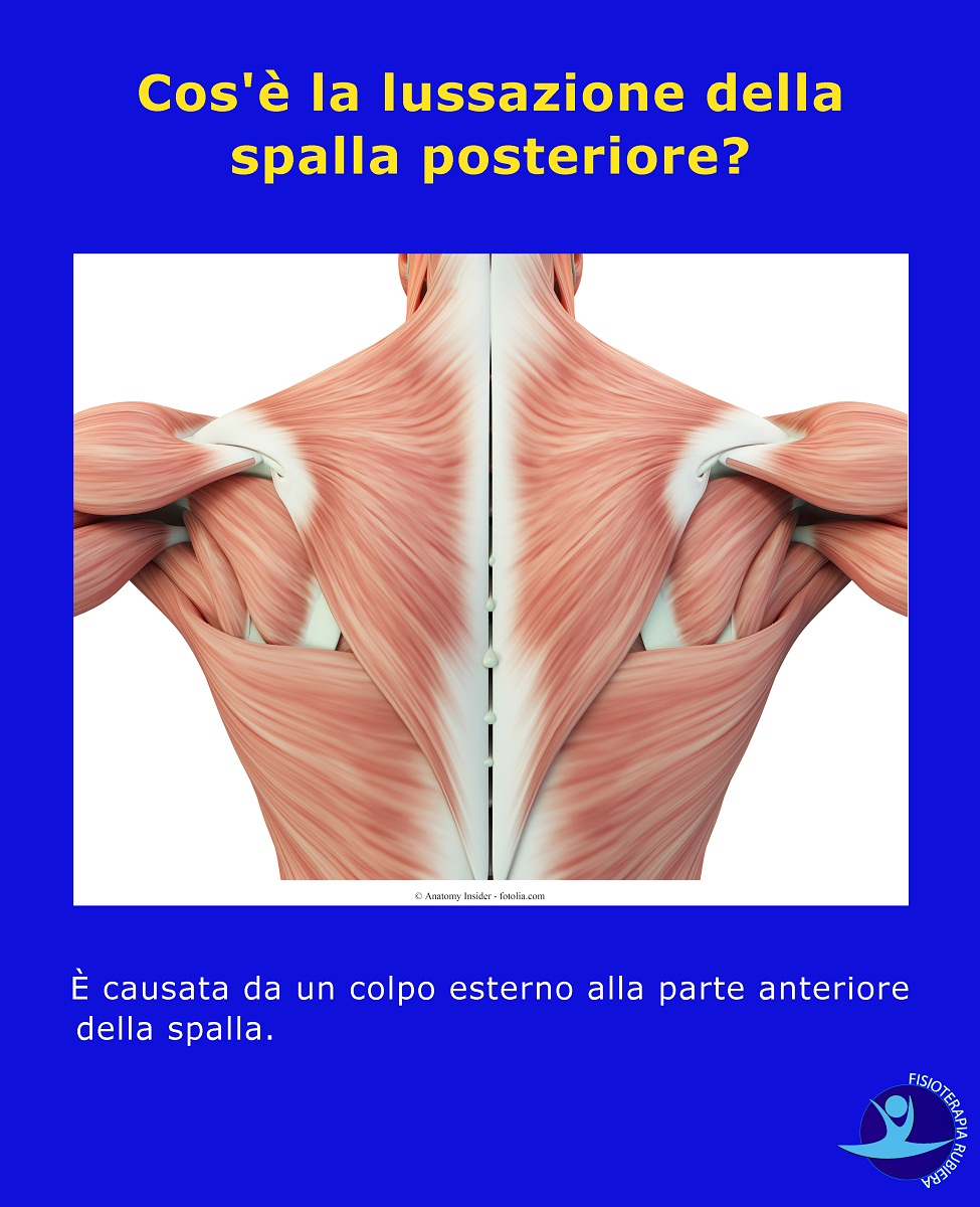 lussazione della spalla posteriore