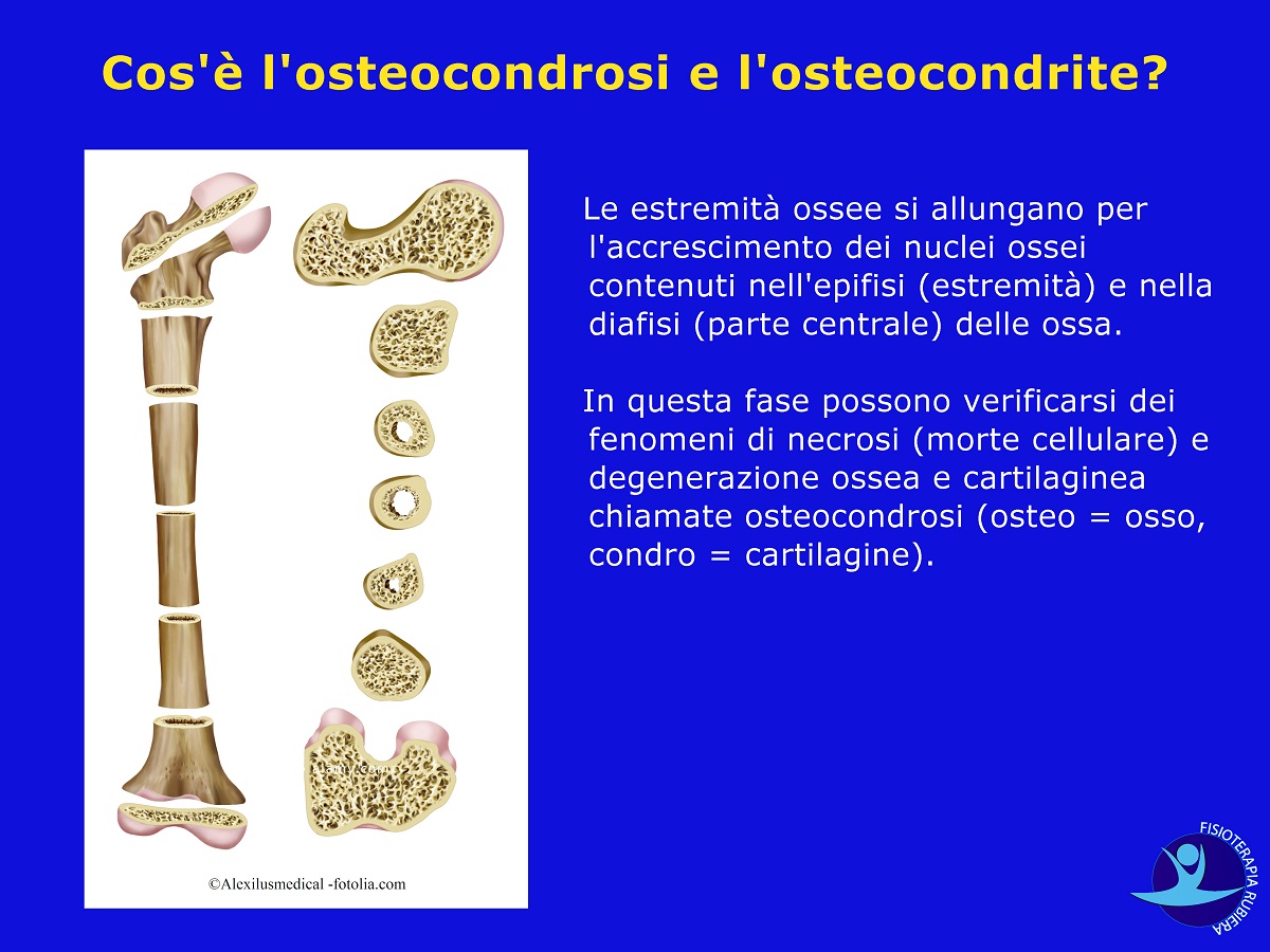 l'osteocondrosi e l'osteocondrite