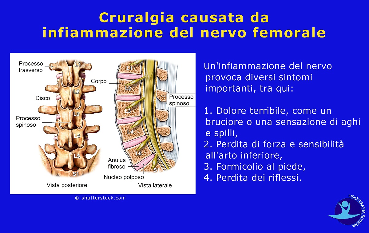 Cruralgia-causata-da-infiammazione-del-nervo-femorale