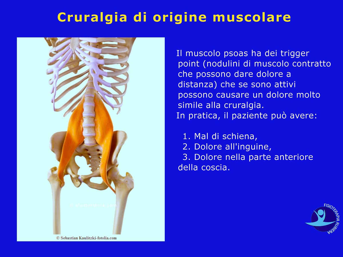 Cruralgia-di-origine-muscolare