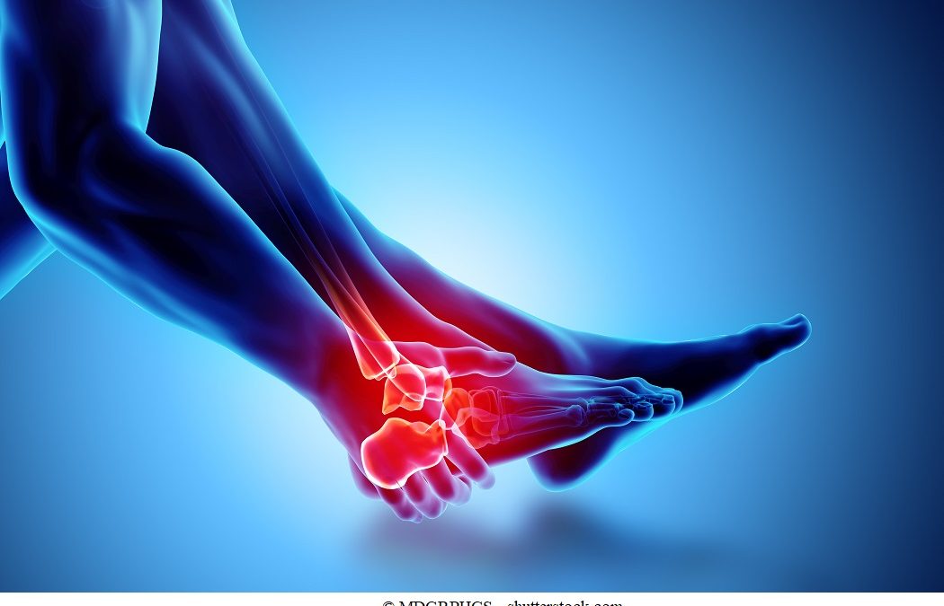 Distorsione alla Caviglia: i Sintomi, la Fisioterapia e gli Esercizi