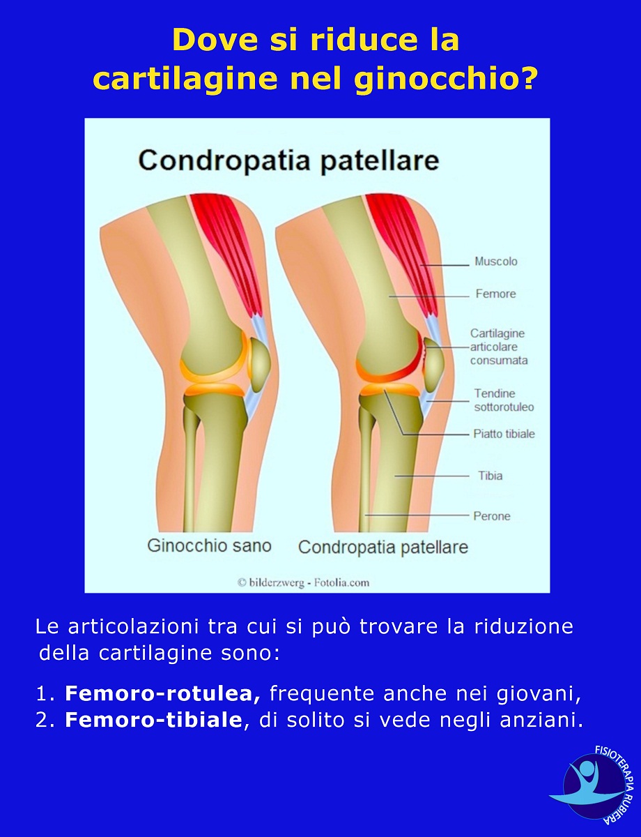 Dove-si-riduce-la-cartilagine-nel-ginocchio
