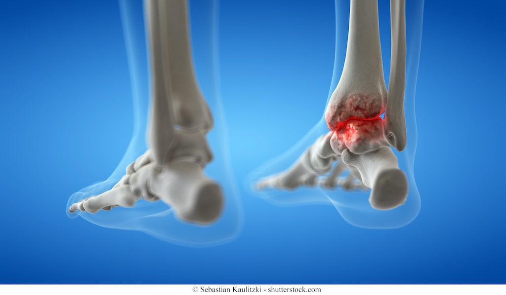 Frattura della Caviglia: i Sintomi, le Complicazioni e la FisioTerapia