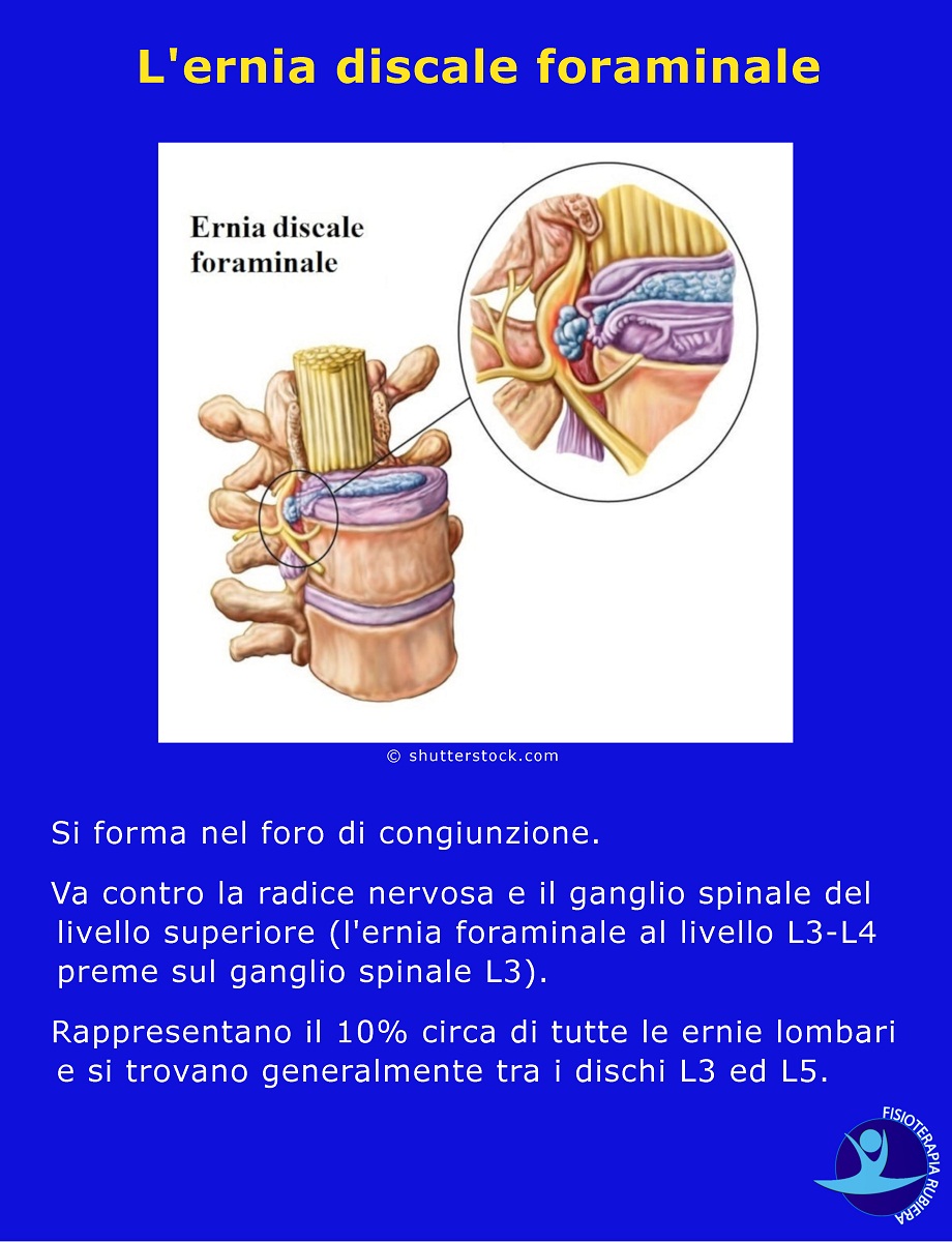 ernia discale foraminale