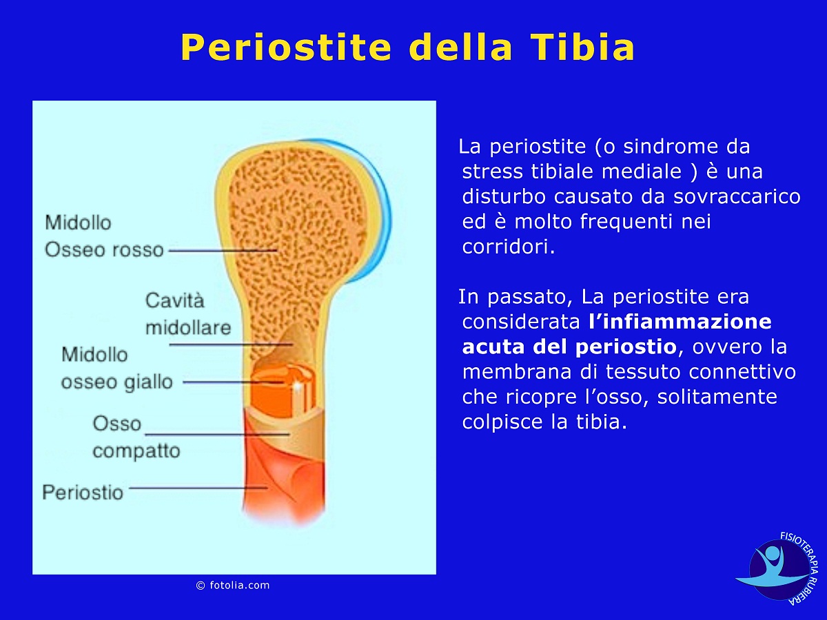 Periostite-della-Tibia