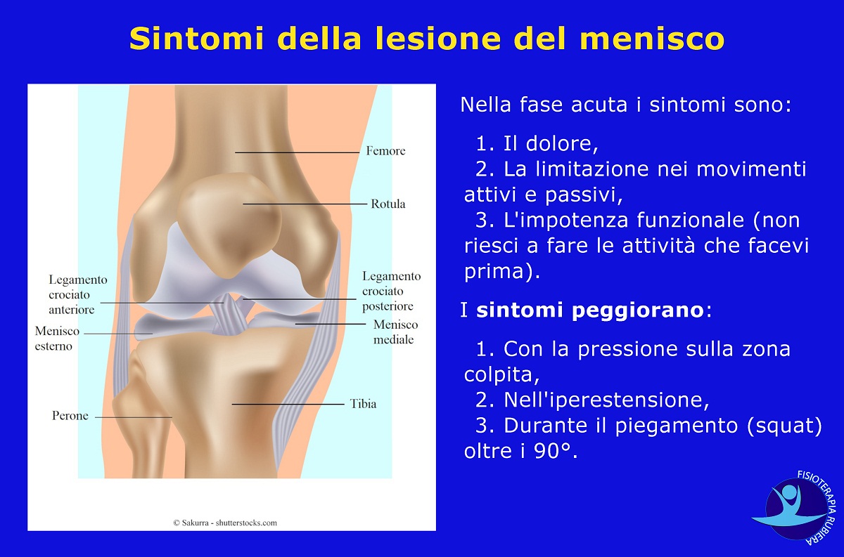 Sintomi-della-lesione-del-menisco