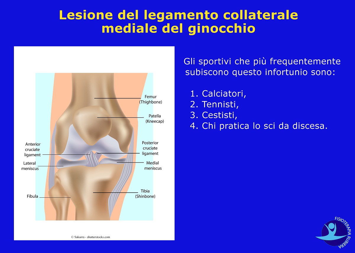 Lesione del legamento collaterale mediale del ginocchio