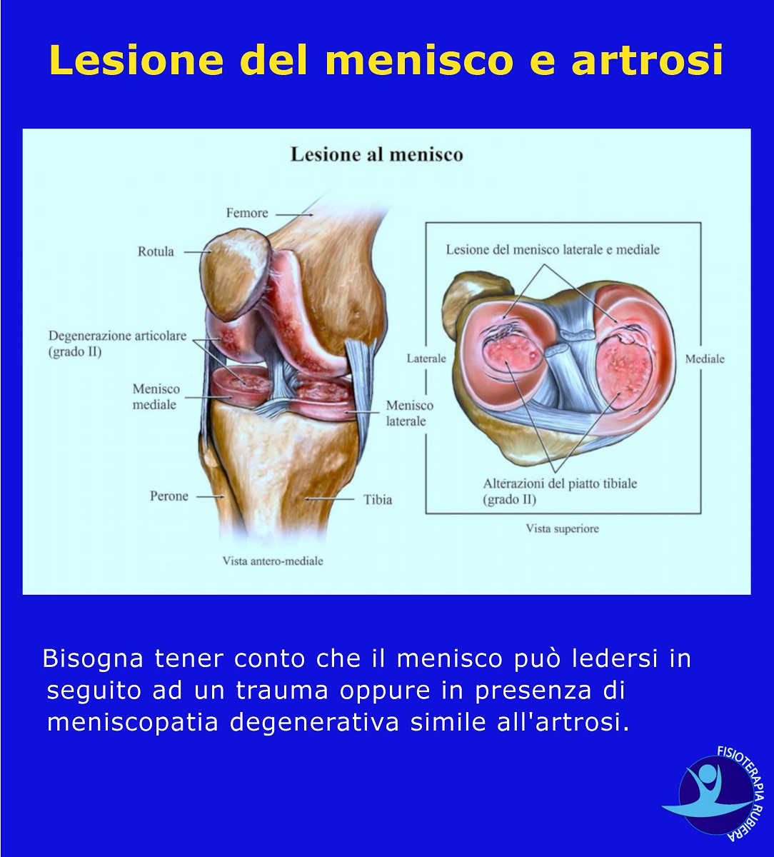 Lesione del menisco e artrosi