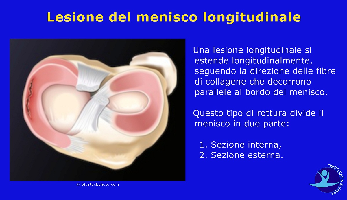 Lesione-del-menisco-longitudinale