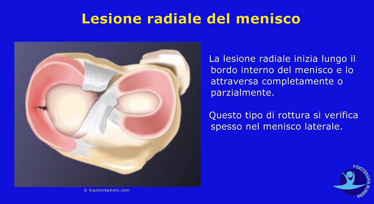 Lesione-radiale-del-menisco