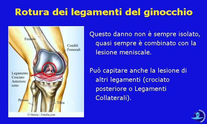 Rottura dei legamenti del ginocchio