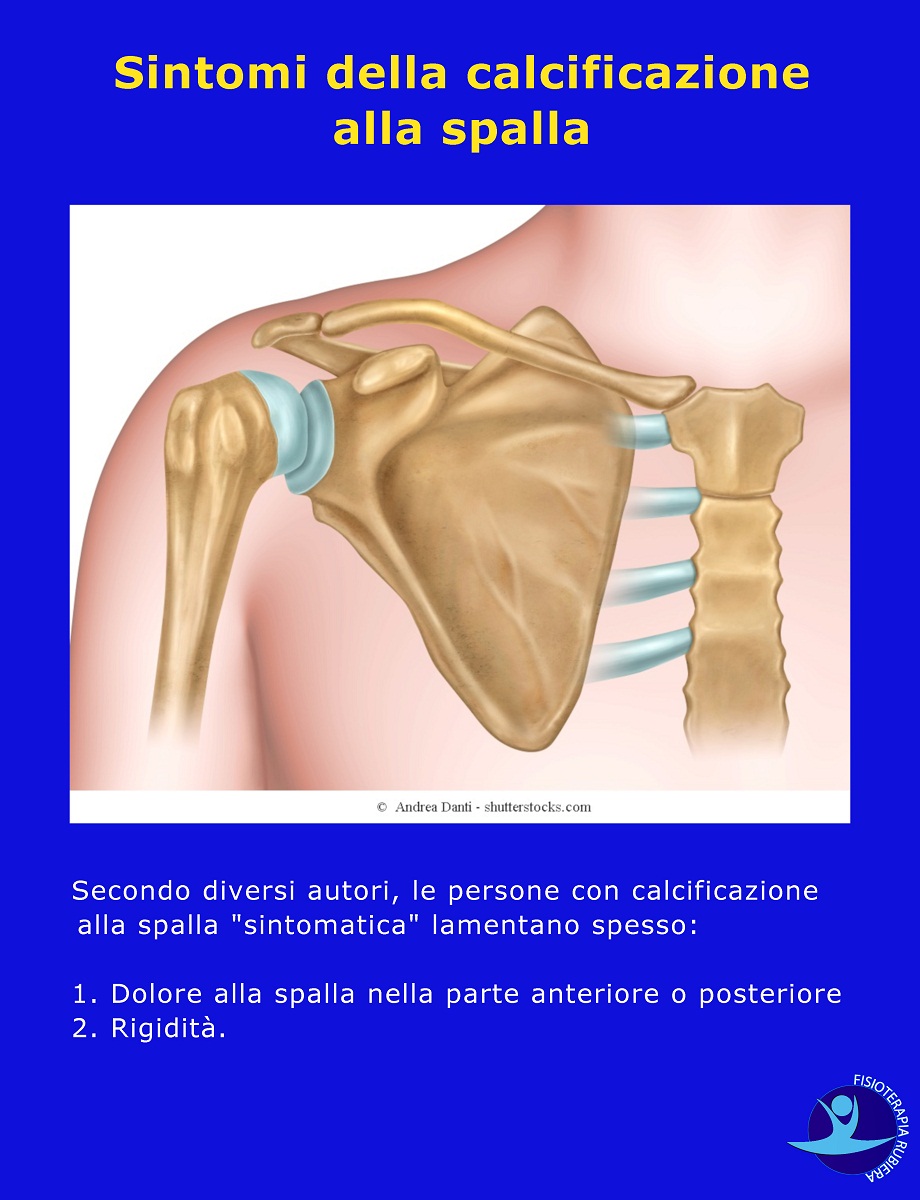 Sintomi della calcificazione alla spalla