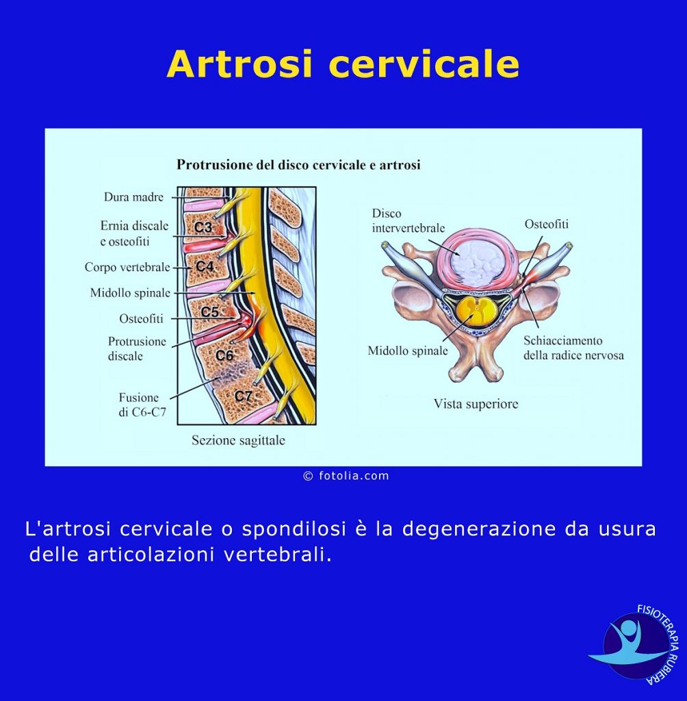 Artrosi cervicale