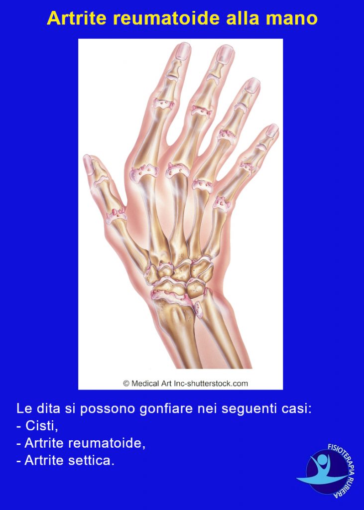 dito-gonfio-artrite-reumatoide