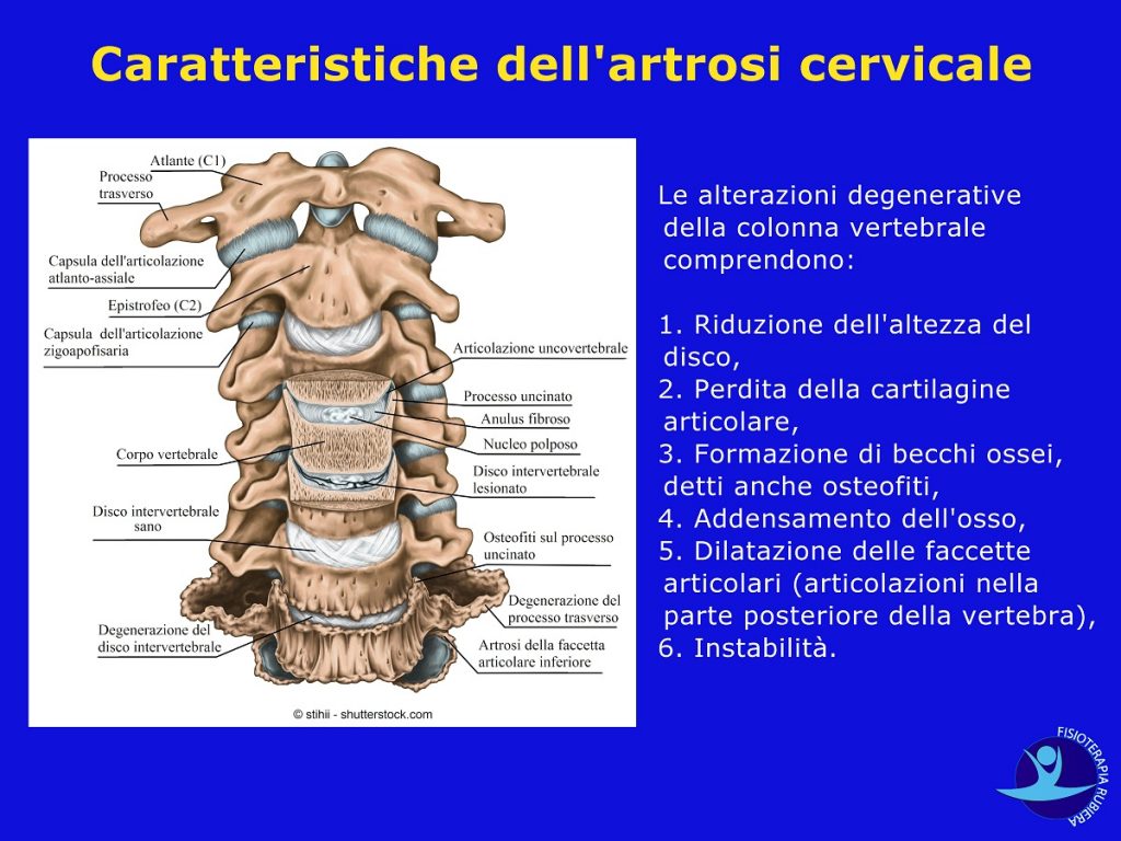 Caratteristiche dell'artrosi cervicale