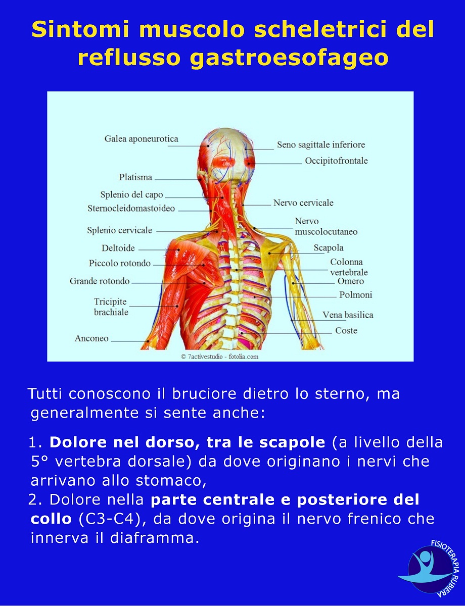 Sintomi-muscolo-scheletrici-del-reflusso-gastroesofageo