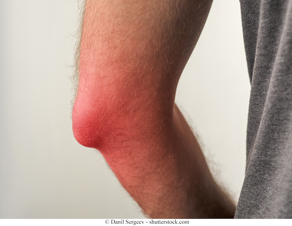 dolori ginocchia e gomiti durerea persistentă în articulațiile cotului provoacă
