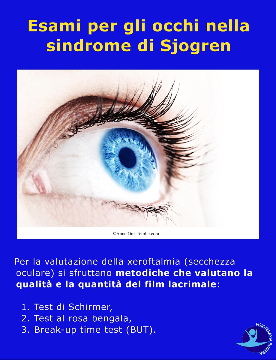 Esami per gli occhi nella sindrome di Sjogren