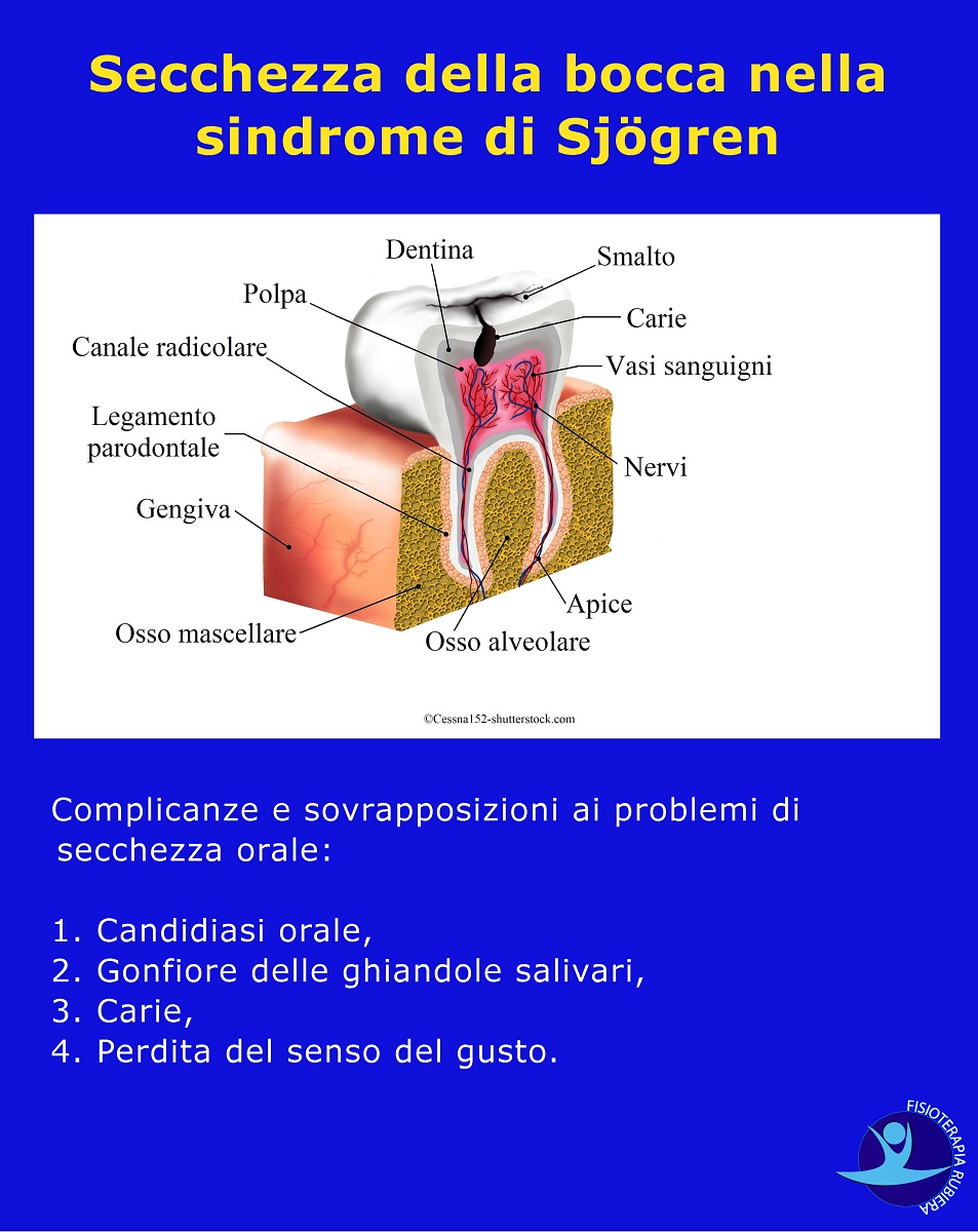 Secchezza-della-bocca-nella-sindrome-di-Sjögren