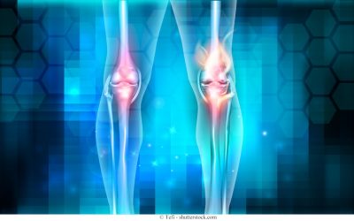 Cause dell’artrosi al ginocchio