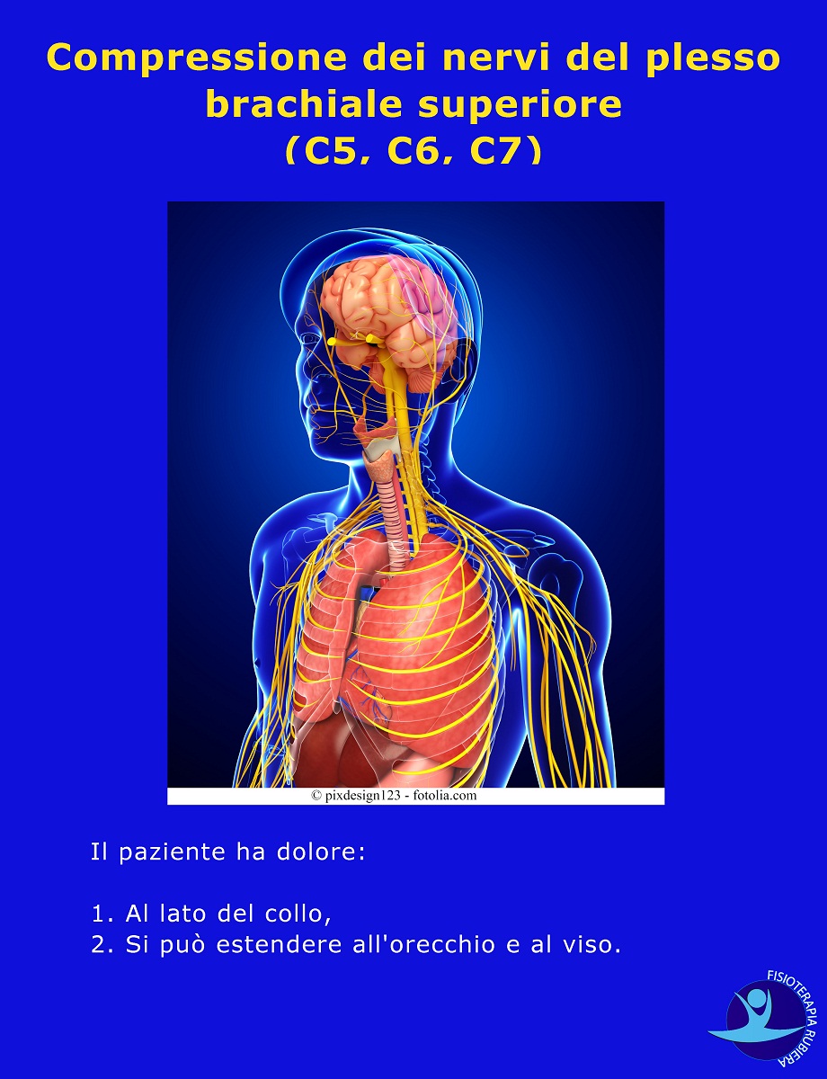 Compressione-dei-nervi-del-plesso-brachiale-superiore-C5-C6-C7