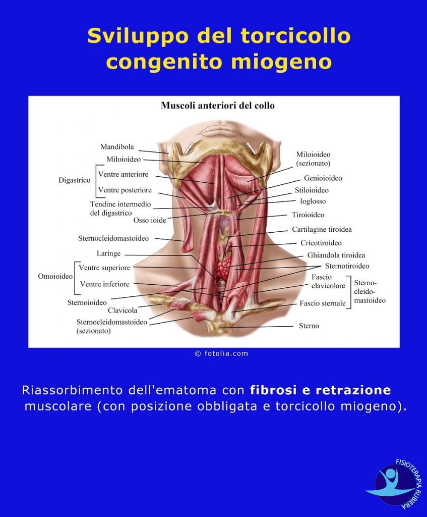 Sviluppo del torcicollo congenito miogeno