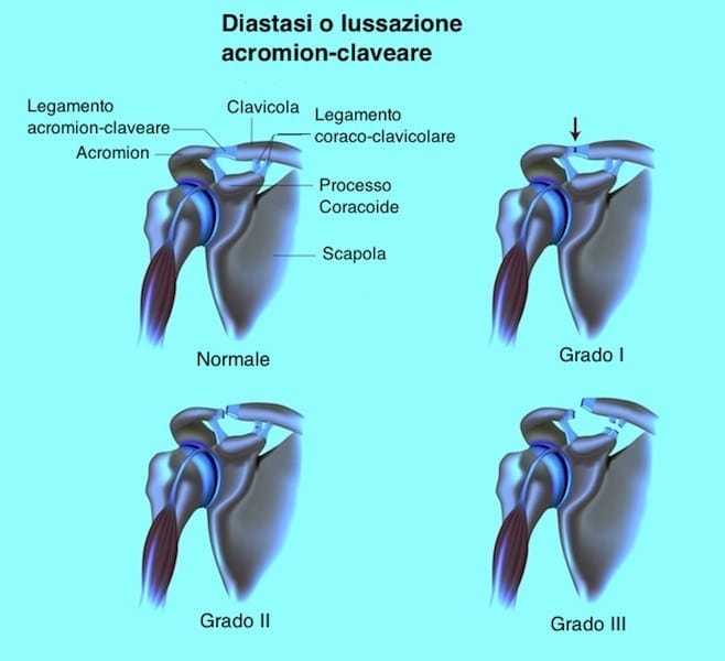 diastasi,lussazione,separazione,acromion,clavicola,spalla