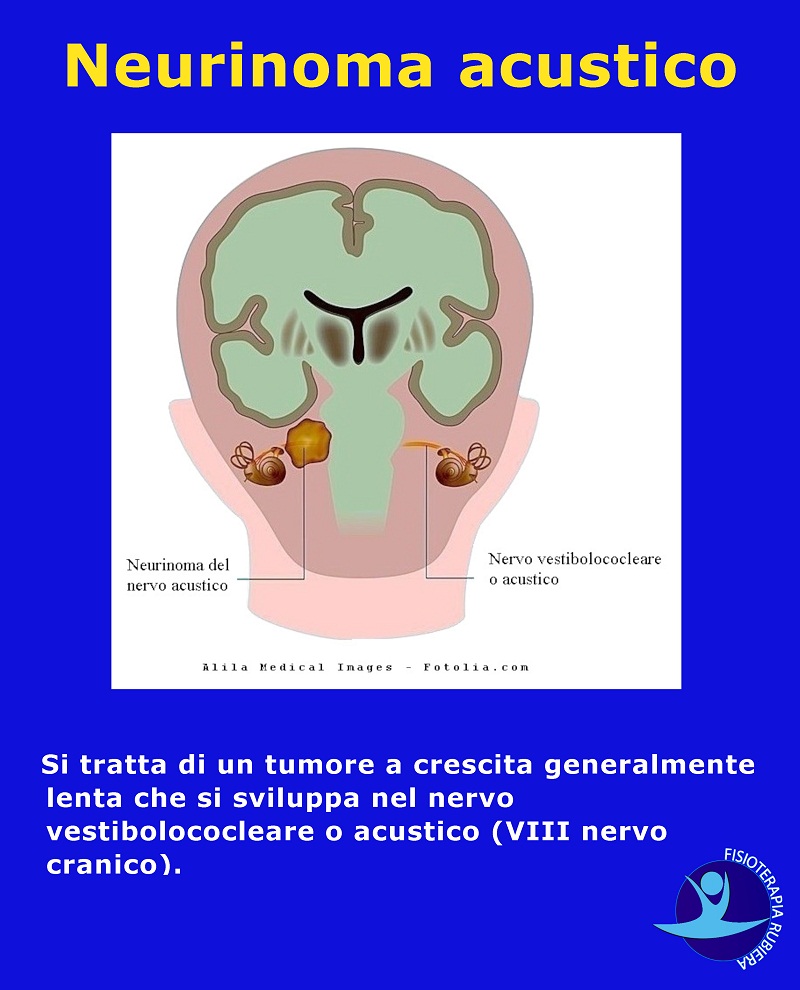 Neurinoma-acustico