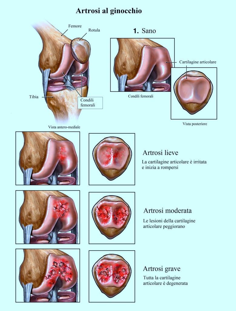 Artrosi al ginocchio,dolore,infiammazione