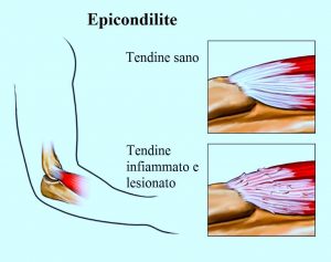 Epicondilite,tendinite del gomito