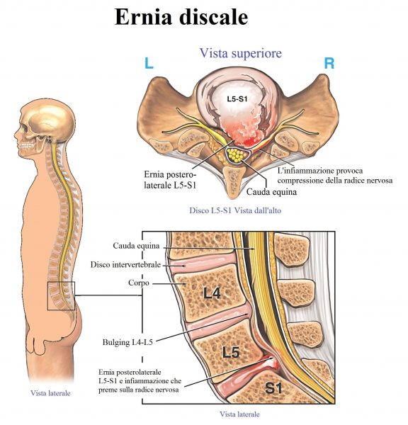 Ernia-del-disco-L5-S1