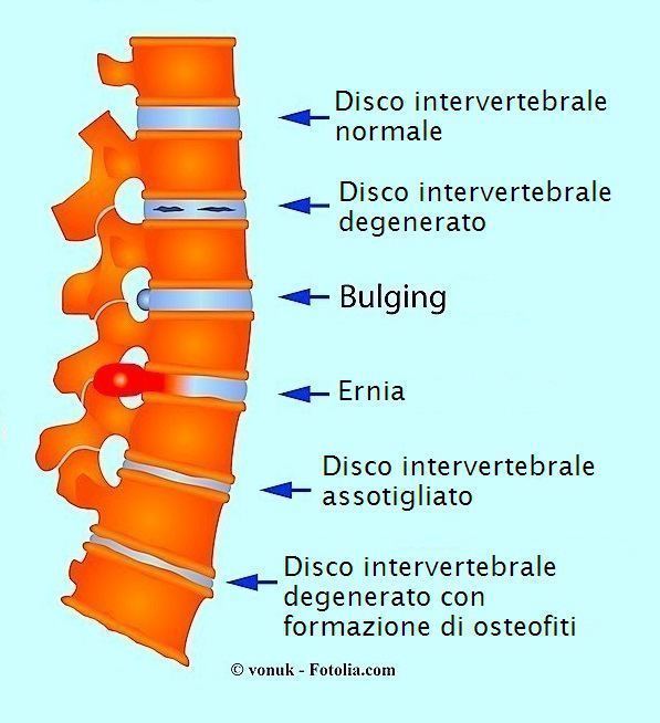Ernia,bulging,artrosi,osteofiti,schiena