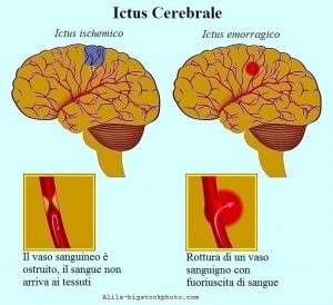 Ictus cerebrale ischemico o emorragico