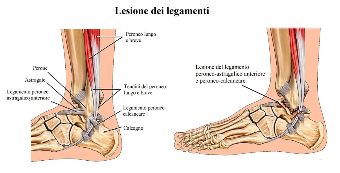 Legamenti della caviglia,lesione,rottura,distorsione,instabilità,peroneo astragalico anteriore,peroneo calcaneare