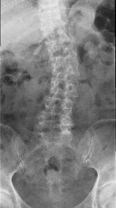 Scoliosi lombare destra convessa., radiografia, rx lombare, ali iliache, ileo, ossa, adolescente, gibbo, lombalgia, mal di schiena, postura