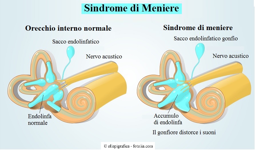 Sindrome-Meniere, endolinfa, orecchio