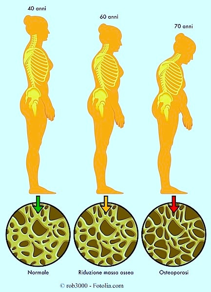 Sintomi dell'osteoporosi e cura