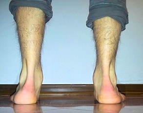 Causa del dolore alla caviglia, supinazione e pronazione