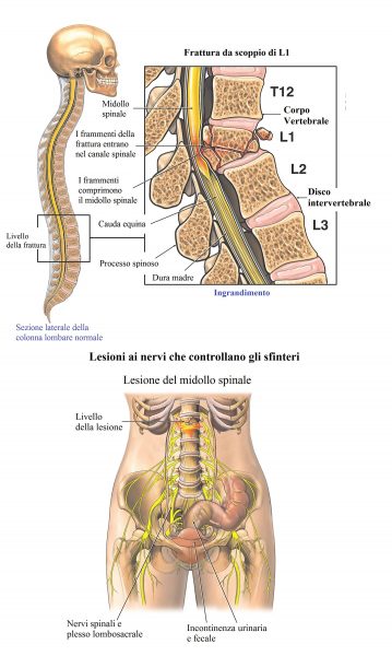 Frattura di L1, da scoppio,lesione midollo spinale,incontinenza