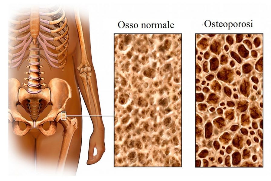 Osteoporosi,anca,femore