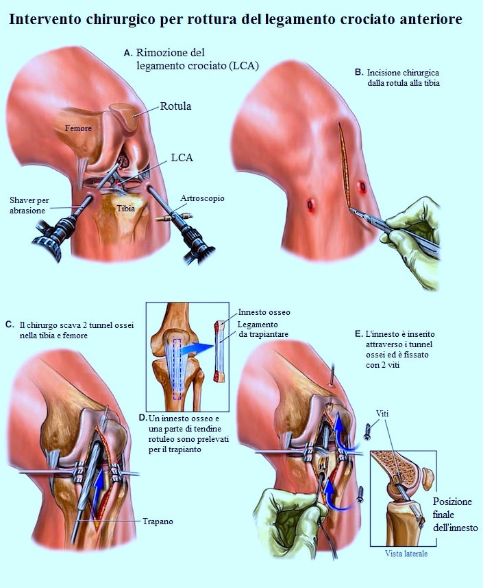 Ricostruzione del legamento crociato anteriore del ginocchio