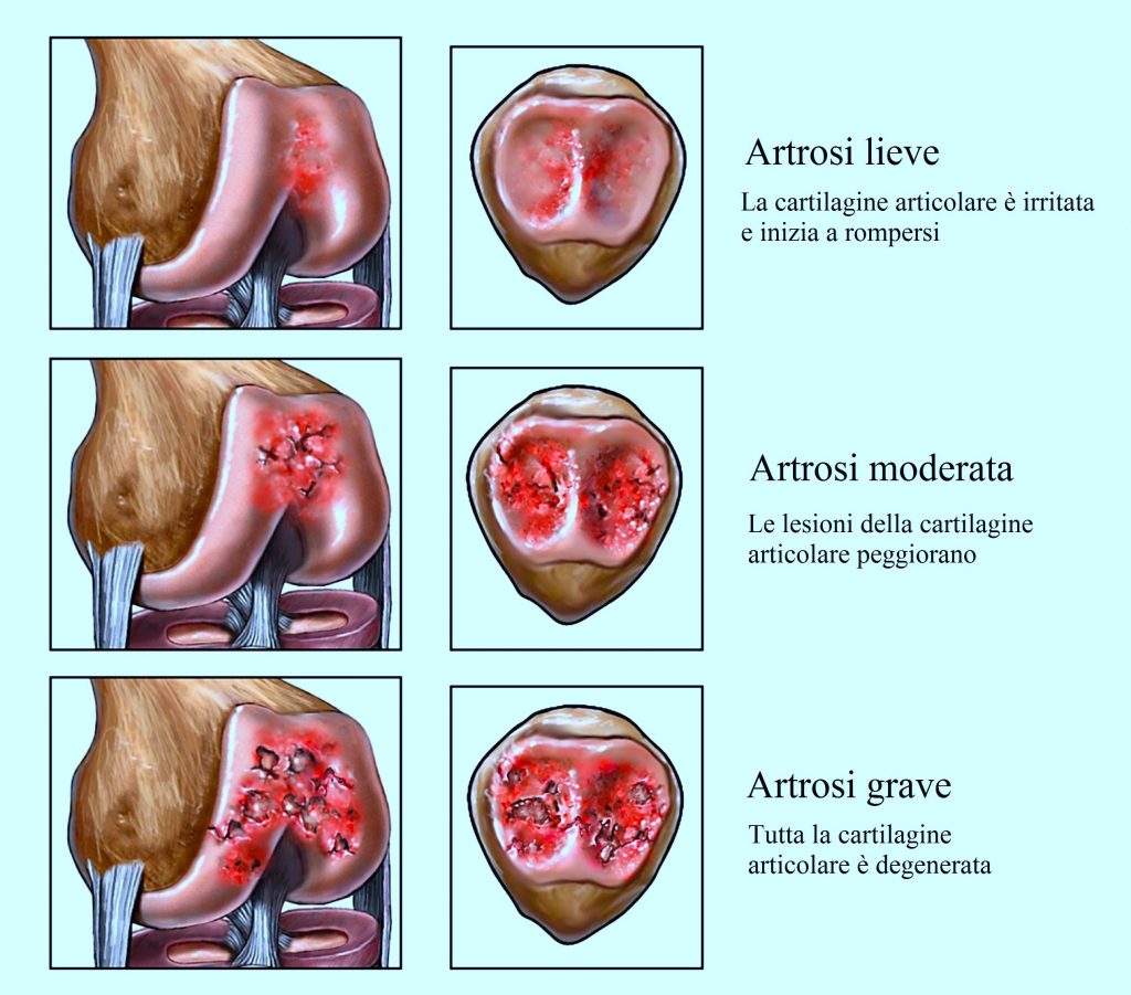 Artrosi al ginocchio,cartilagine,acido ialuronico
