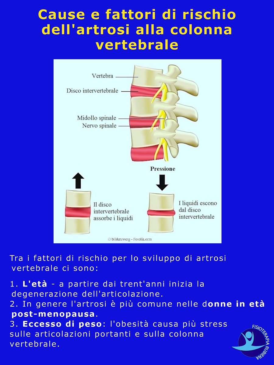 fattori-di-rischio-dellartrosi-alla-colonna-vertebrale
