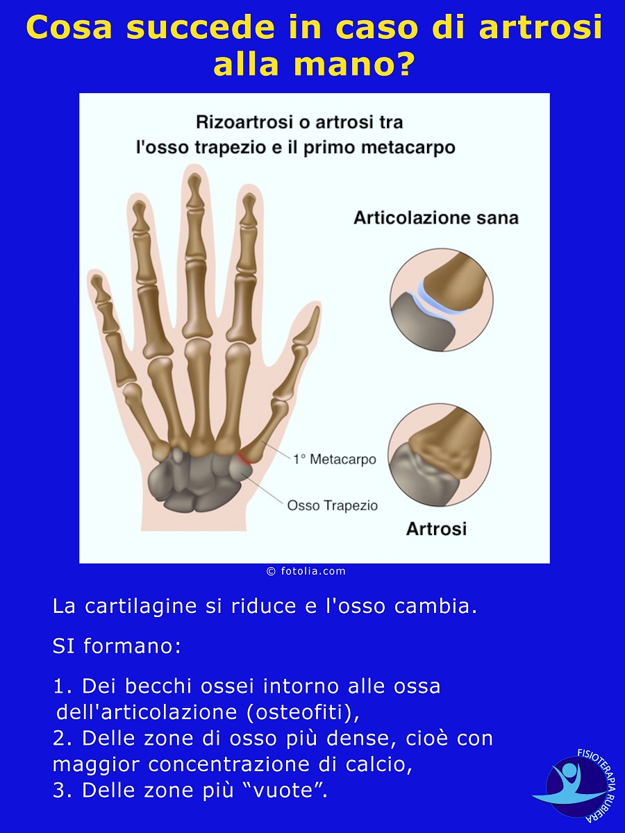 Cosa succede in caso di artrosi alla mano