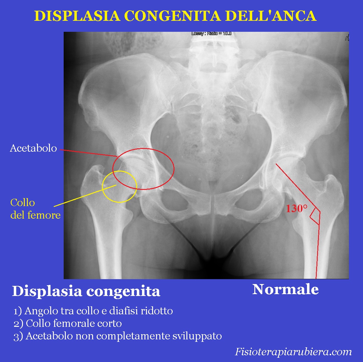 Displasia-congenita-dell'anca